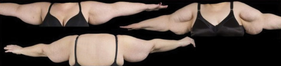 Imagens ilustrativas da lipedema nos braços, 3 estágios desde leve até severo