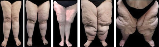 Imagens ilustrativas da lipedema nas pernas, 5 estágios desde leve até severo
