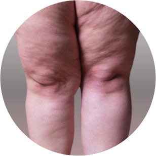 Exemplo de Lipedema na região das pernas